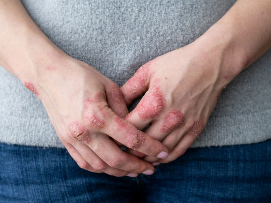 eczema