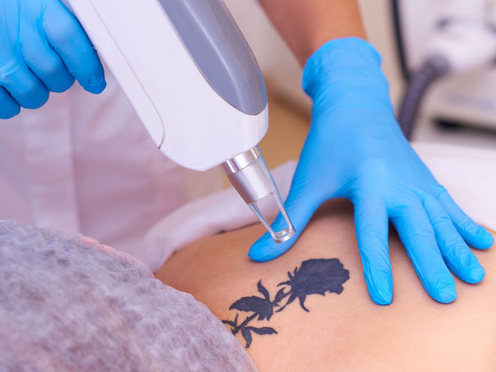Non-ablative laser tattoo removal techniques