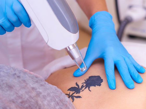 Omaha Cosmetic Surgery Tattoo Removal | Schlessinger MD | LovelySkin™